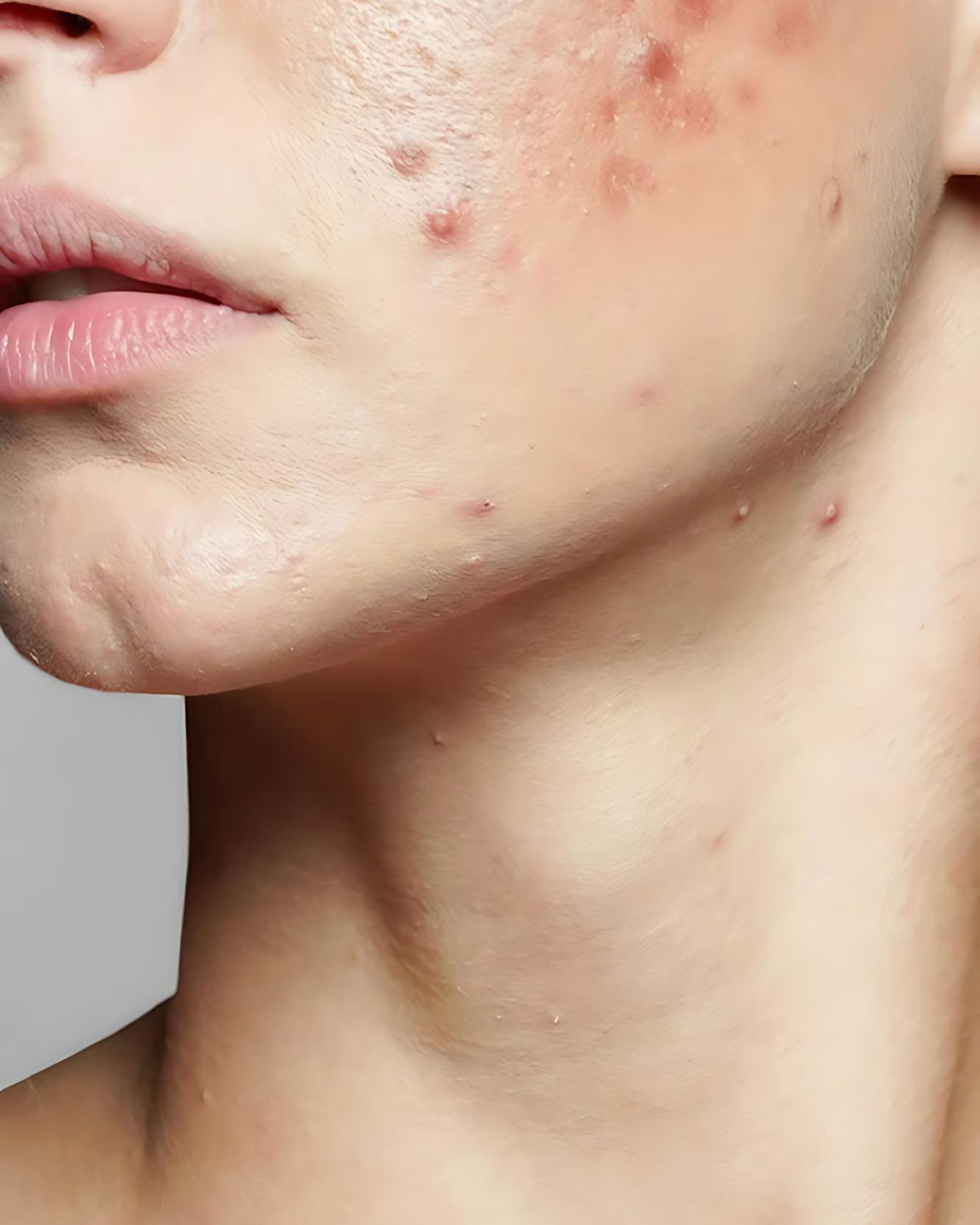 Acne