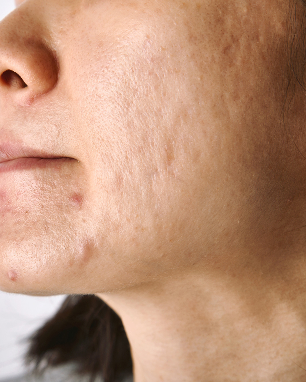 Acne Scars