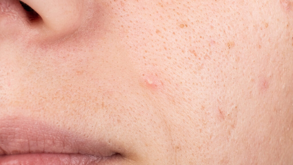 Dull Skin