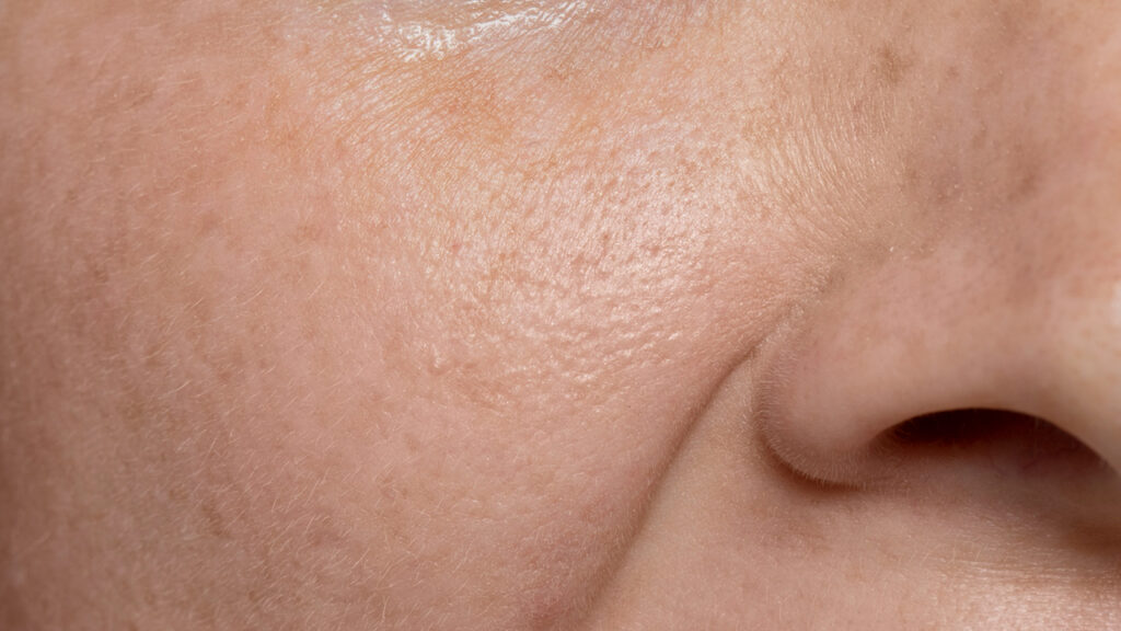 Dull Skin