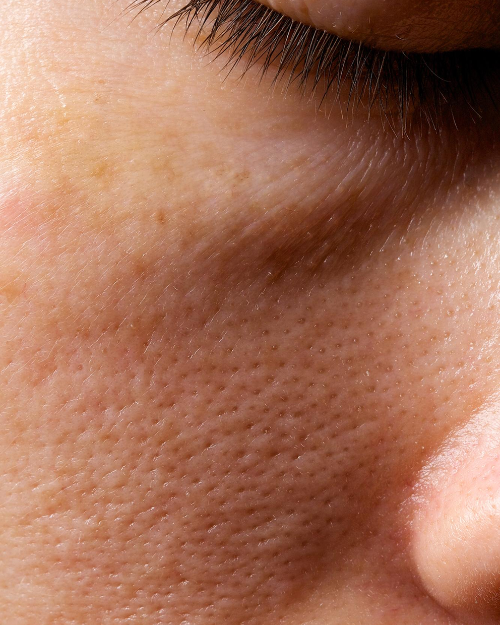 Enlarged pore