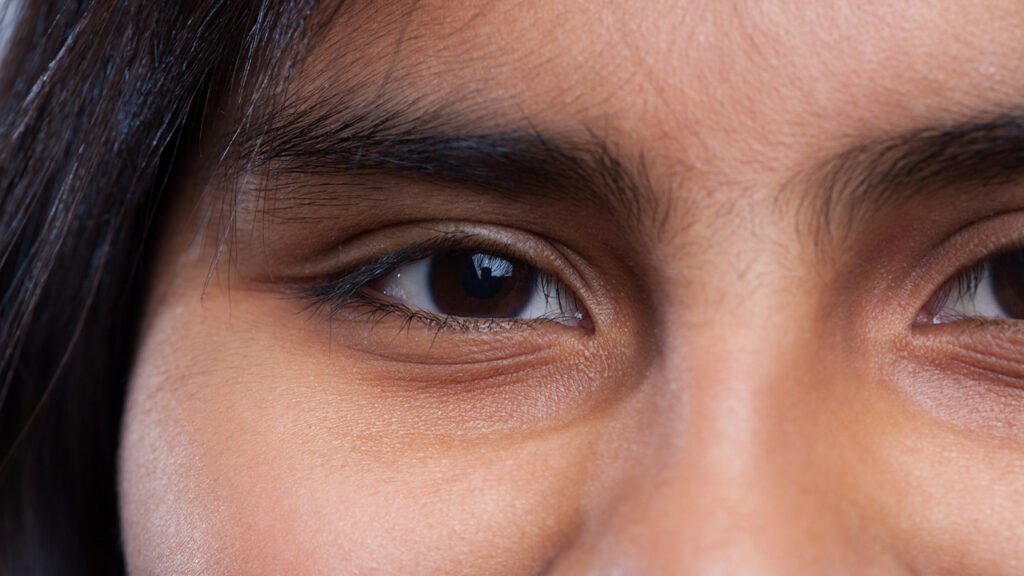 Eye Bag