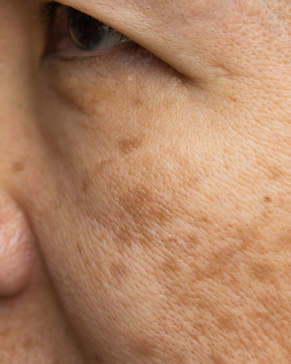 Melasma