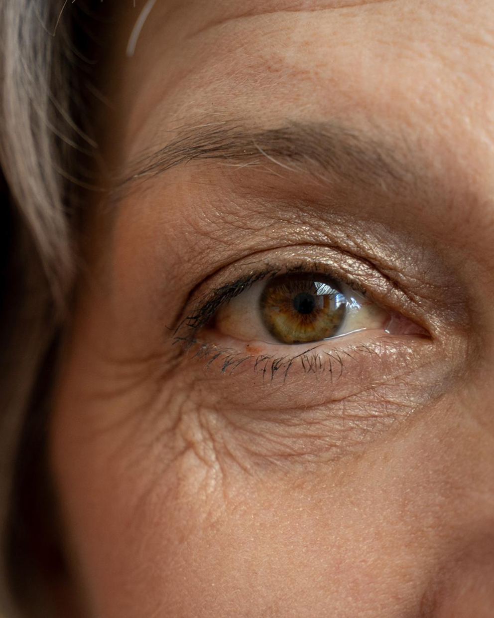 Periorbital Eye Aging