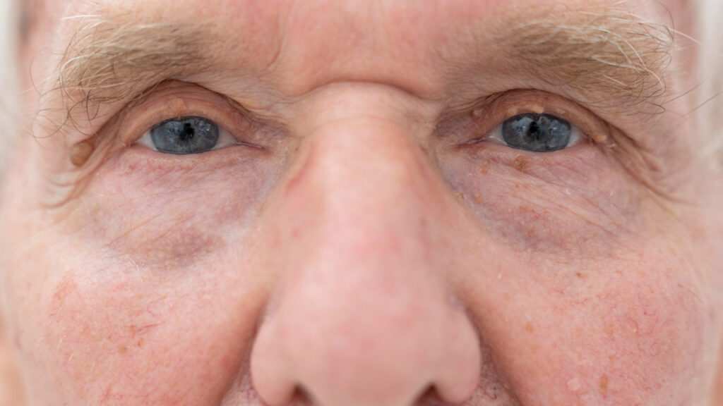 Periorbital Eye Aging