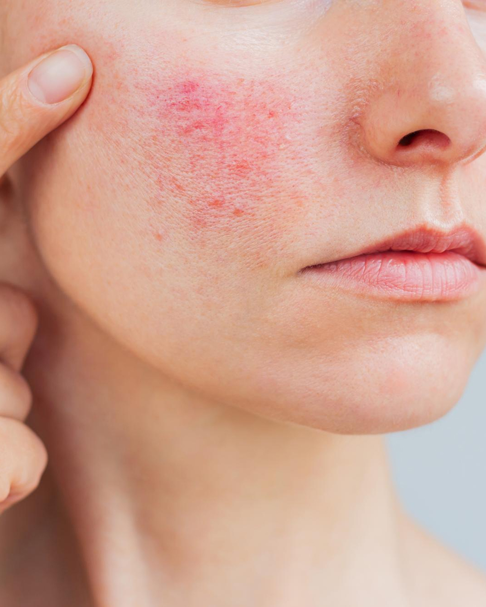 Rosacea or redness