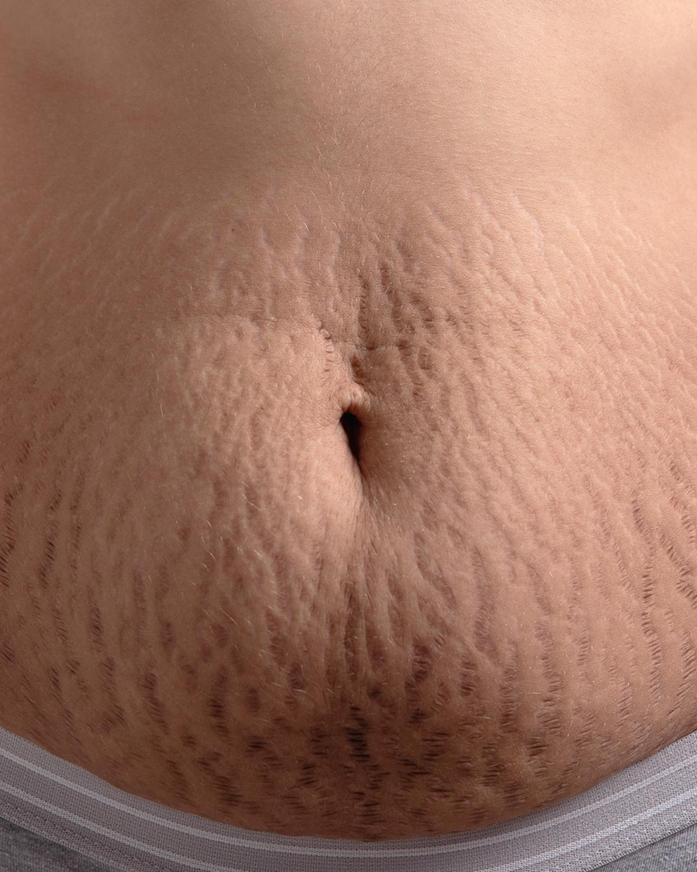 Stretch Mark