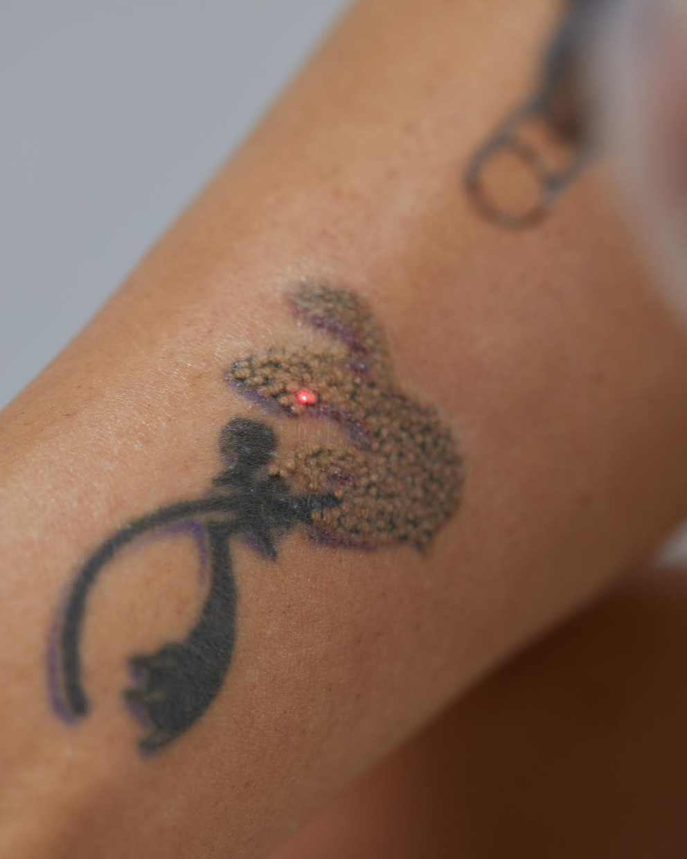 Laser handpiece treating a floral tattoo on a forearm