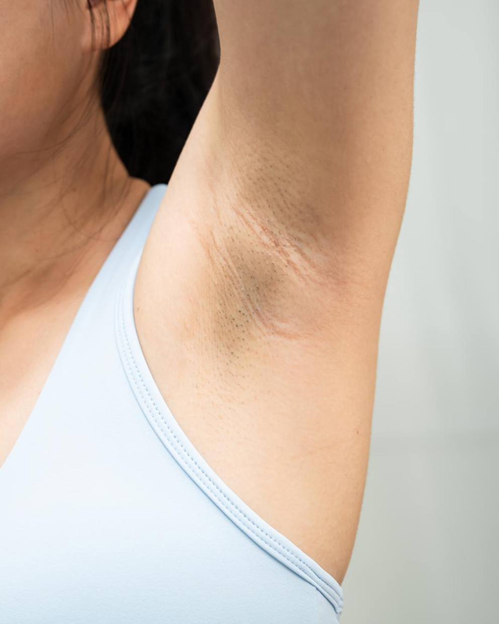 Underarm Pigmentation