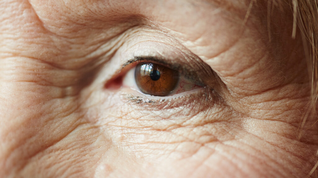 Wrinkles